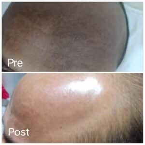 Remove melasma in Nadara Clinic